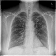 Röntgenuntersuchung der Thorax-Spiralen (Coils) zur Therapie des Lungenemphysems